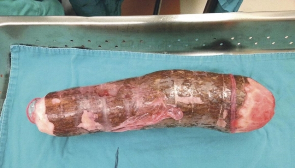CIRURGIA - Para retirar 45cm de mandioca, costa-riquenho teve que ser operado
